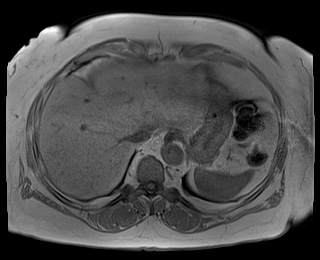 File:Adrenal cortical carcinoma (Radiopaedia 64017-72770 Axial T1 in-phase 7).jpg