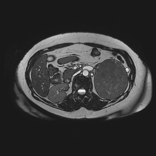 File:Adrenal cortical carcinoma (Radiopaedia 70906-81116 Axial FIESTA 29).jpg