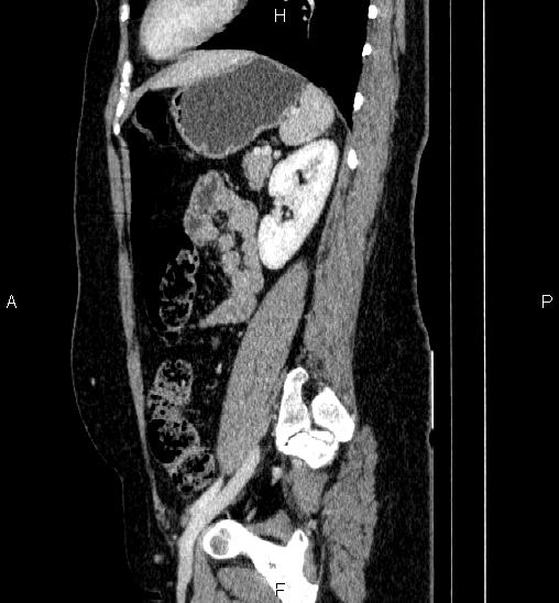 File:Adrenal cortical carcinoma (Radiopaedia 84882-100379 Sagittal C+ portal venous phase 62).jpg