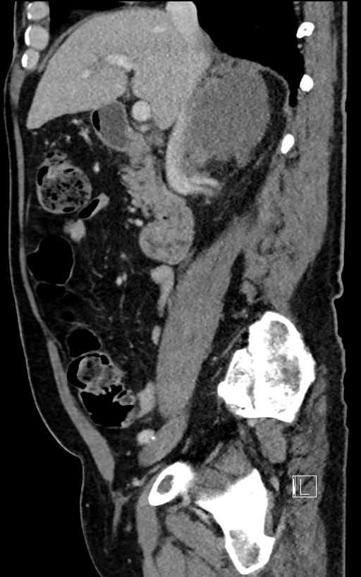 Adrenal lymphoma (Radiopaedia 73730-84529 Sagittal C+ portal venous phase 44).jpg