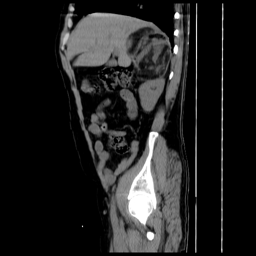 File:Adrenal myelolipoma (Radiopaedia 41843-44834 Sagittal non-contrast 8).jpg
