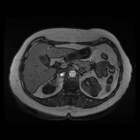 File:Adrenal myelolipoma - MRI (Radiopaedia 83249-97646 T1 out-of-phase 10).jpg