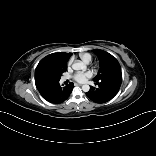 Adrenocortical carcinoma (Radiopaedia 87281-103569 Axial C+ portal venous phase 1).jpg