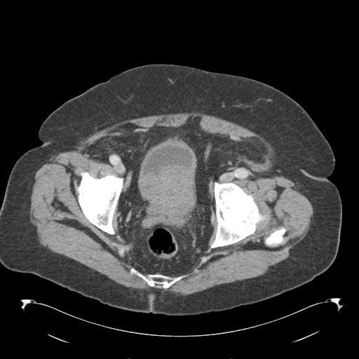 Adult ileal intussusception with secondary obstruction (Radiopaedia 30395-31051 Axial C+ portal venous phase 70).jpg