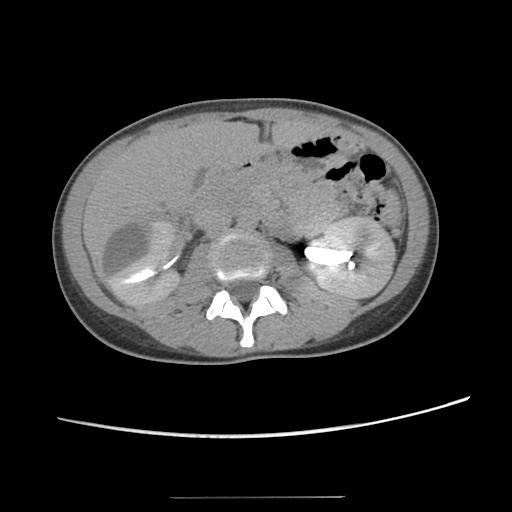 Adult polycystic kidney disease (Radiopaedia 48845-53876 Axial renal excretory phase 41).jpg