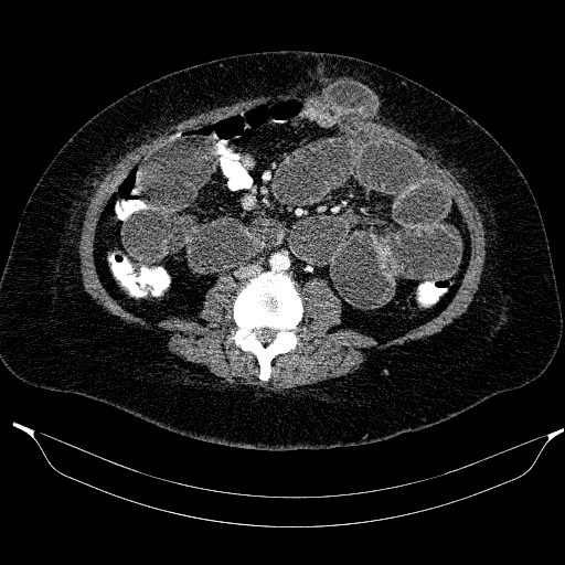 Afferent loop syndrome - secondary to incarcerated trocar site hernia (Radiopaedia 82959-97305 Axial C+ portal venous phase 136).jpg