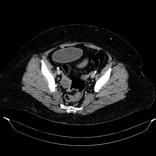 Afferent loop syndrome - secondary to incarcerated trocar site hernia (Radiopaedia 82959-97305 Axial C+ portal venous phase 199).jpg