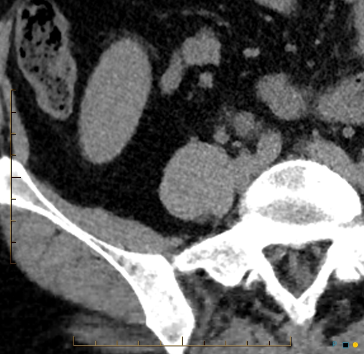 Aggressive angiomyolipoma (Radiopaedia 55765-62328 Axial non-contrast 57).jpg
