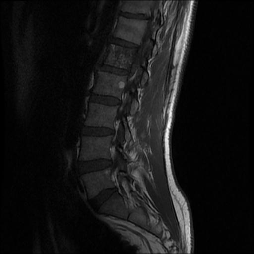 File:Aggressive vertebral hemangioma with pathological fracture (Radiopaedia 69528-79411 Sagittal T1 7).jpg
