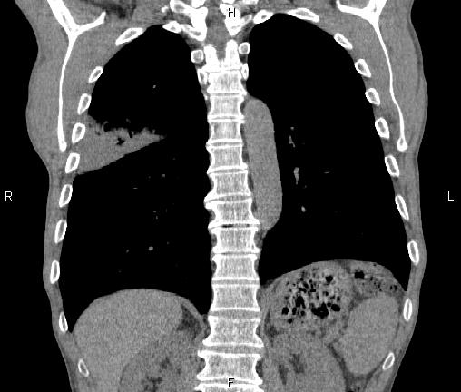 Air bronchogram in pneumonia (Radiopaedia 85719-101512 Coronal non-contrast 41).jpg