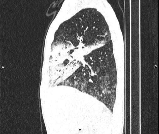Air bronchogram in pneumonia (Radiopaedia 85719-101512 Sagittal lung window 32).jpg