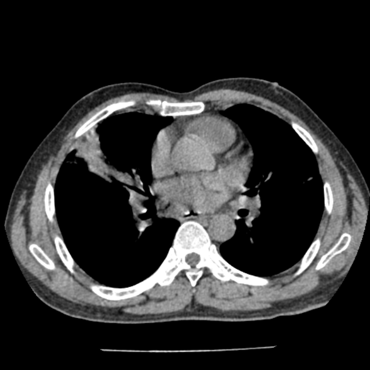 Airway foreign body in adult (Radiopaedia 85907-101779 Axial liver window 96).jpg