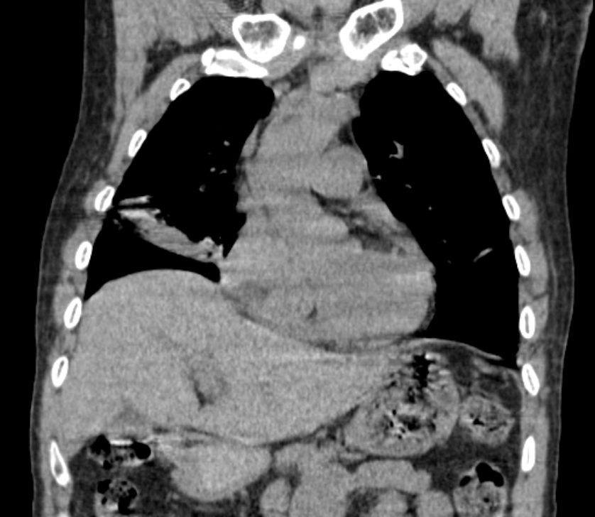 Airway foreign body in adult (Radiopaedia 85907-101779 Coronal liver window 91).jpg