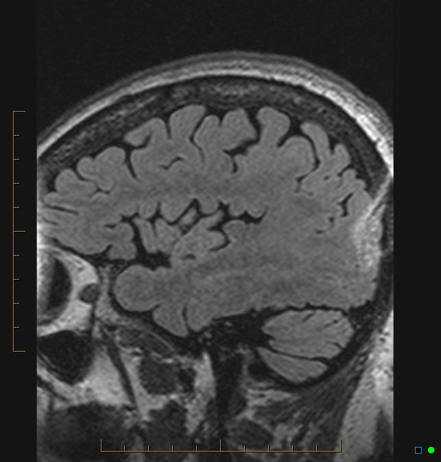 Aliasing artifact causing a spurious cerebellar lesion (Radiopaedia 48783-53810 Sagittal FLAIR 107).jpg