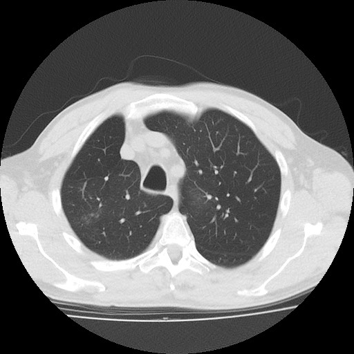 Allergic bronchopulmonary aspergillosis (ABPA) (Radiopaedia 60594-68313 Axial lung window 13).jpg