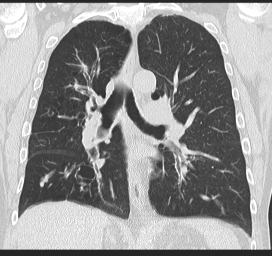 Allergic bronchopulmonary aspergillosis (Radiopaedia 44760-48571 Coronal lung window 33).png