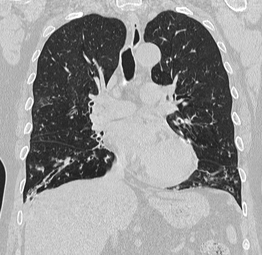 Alpha-1-antitrypsin deficiency (Radiopaedia 72058-82557 Coronal lung window 38).jpg