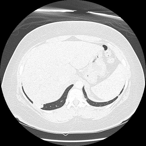 Alveolar soft part sarcoma - right leg (Radiopaedia 59432-67091 Axial lung window 104).jpg