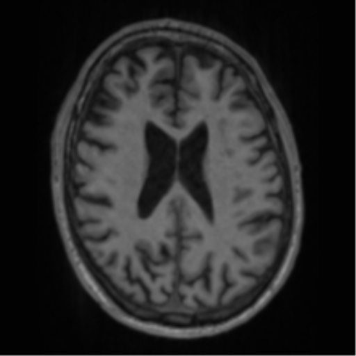 Alzheimer's disease- with apraxia (Radiopaedia 54763-61011 Axial T1 47).png