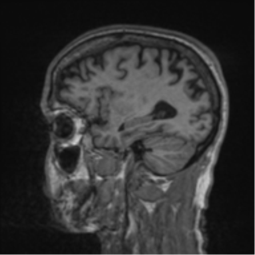 File:Alzheimer's disease- with apraxia (Radiopaedia 54763-61011 Sagittal T1 51).png