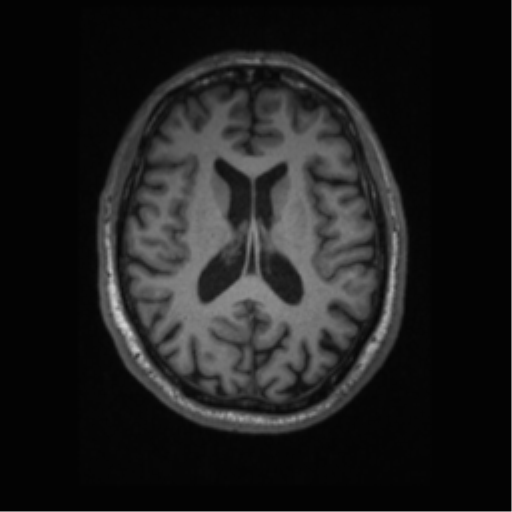 Alzheimer disease - probable (Radiopaedia 35334-36837 Axial T1 45).png