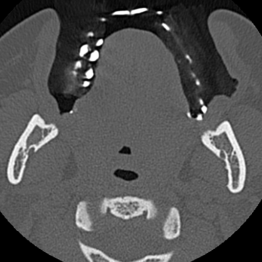 File:Ameloblastic fibro-odontoma (Radiopaedia 18843-18780 C 58).jpg