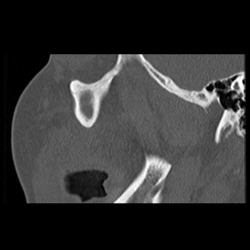 File:Ameloblastic fibro-odontoma (Radiopaedia 18843-18780 bone window 14).jpg