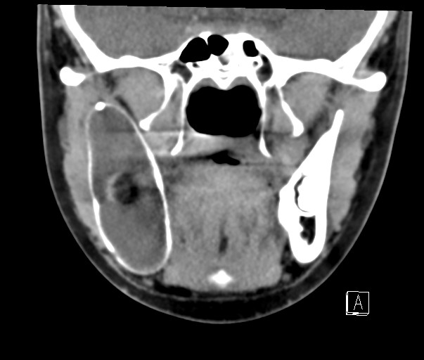 File:Ameloblastoma (Radiopaedia 26645-26793 Coronal C+ delayed 7).jpg