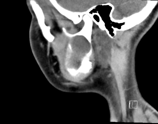 File:Ameloblastoma (Radiopaedia 26645-26793 Sagittal C+ delayed 4).jpg