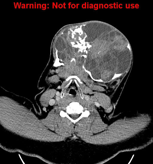 File:Ameloblastoma (Radiopaedia 33126-34164 B 20).jpg