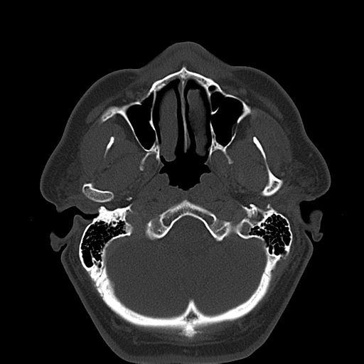 Ameloblastoma (Radiopaedia 38520-40623 Axial bone window 17).png