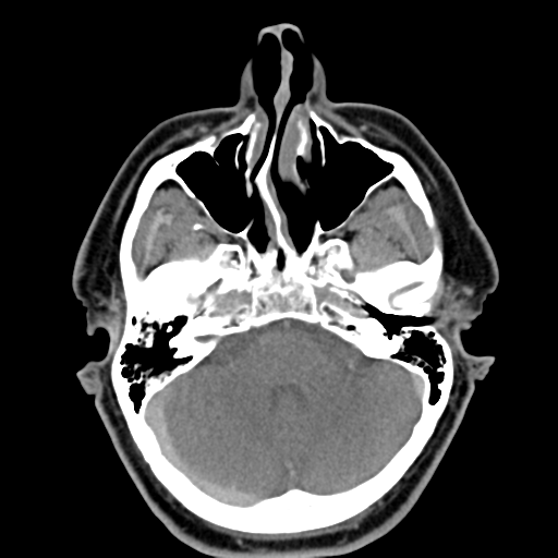 Ameloblastoma (Radiopaedia 38520-40623 Axial non-contrast 12).png