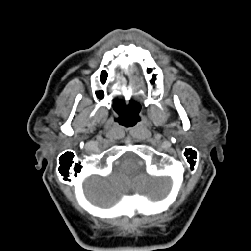 Ameloblastoma (Radiopaedia 38520-40623 Axial non-contrast 20).png