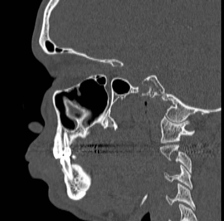 Ameloblastoma (Radiopaedia 77750-89997 Sagittal bone window 20).jpg