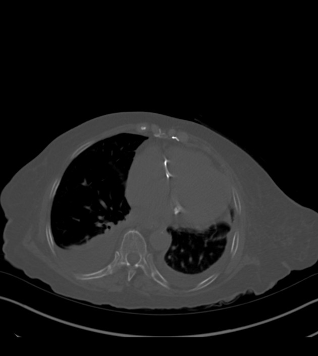 Amiodarone deposition in the liver (Radiopaedia 77587-89780 Axial bone window 58).jpg