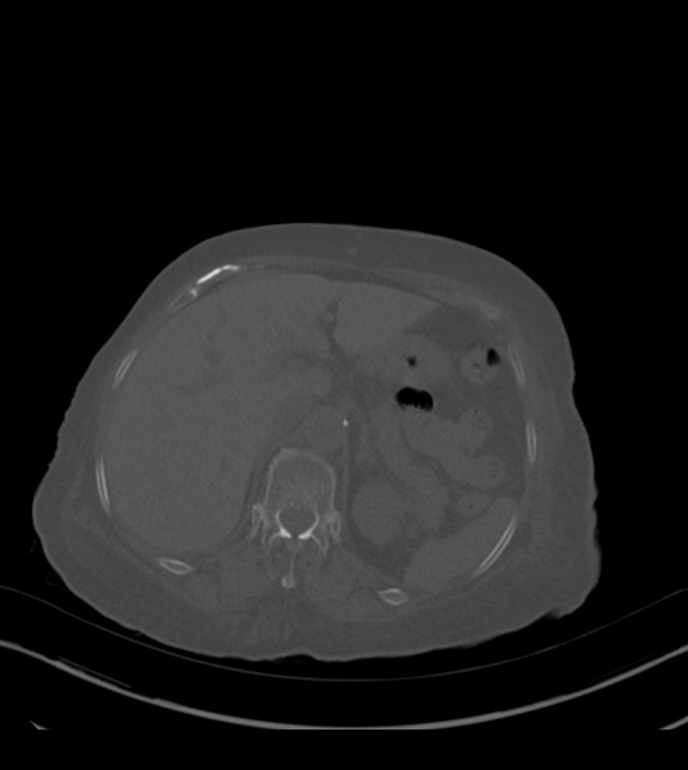 Amiodarone deposition in the liver (Radiopaedia 77587-89780 Axial bone window 83).jpg