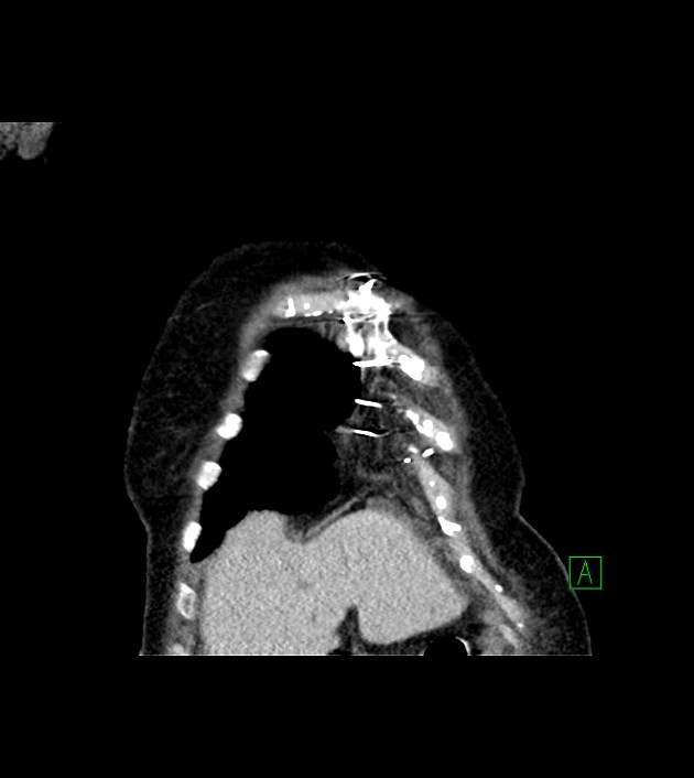 Amiodarone deposition in the liver (Radiopaedia 77587-89780 Coronal non-contrast 15).jpg