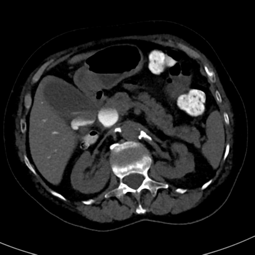 File:Ampullary adenocarcinoma (Radiopaedia 34013-35241 AXIAL THICK 31).png