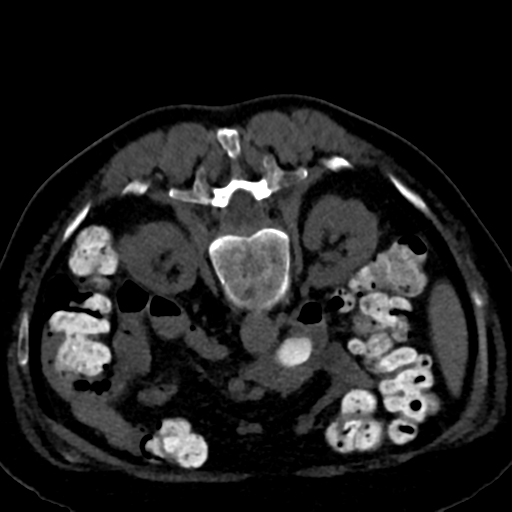 Ampullary adenocarcinoma (Radiopaedia 34013-35241 C 49).png