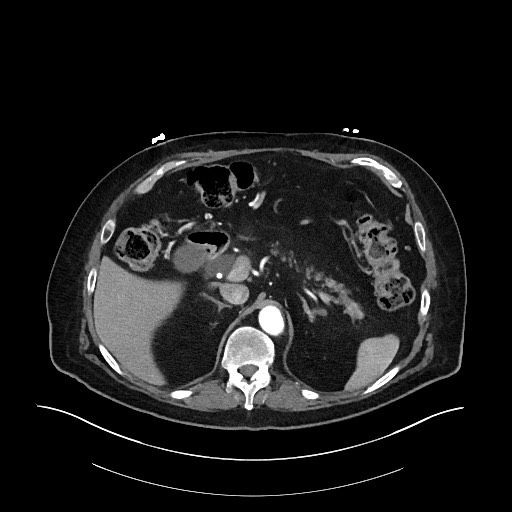 Ampullary adenocarcinoma (Radiopaedia 59373-66734 A 51).jpg