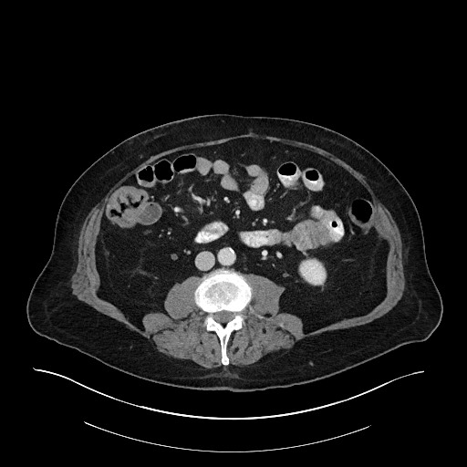 Ampullary adenocarcinoma (Radiopaedia 59373-66734 C 89).jpg