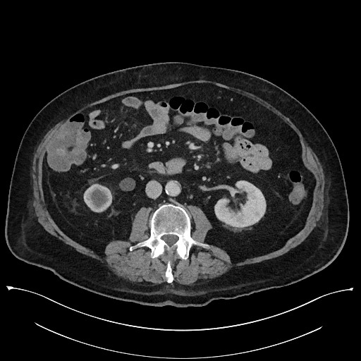 Ampullary adenocarcinoma (Radiopaedia 59373-66737 A 85).jpg