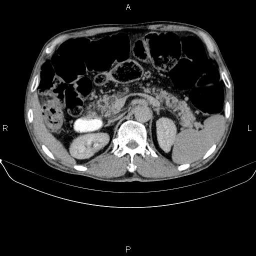 Ampullary adenocarcinoma (Radiopaedia 86093-102032 Axial C+ delayed 32).jpg
