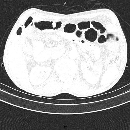 Ampullary adenocarcinoma (Radiopaedia 86093-102033 Axial lung window 61).jpg