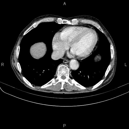 Ampullary adenocarcinoma (Radiopaedia 86093-102033 B 43).jpg