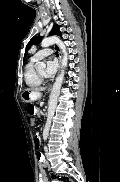 Ampullary adenocarcinoma (Radiopaedia 86093-102033 E 52).jpg