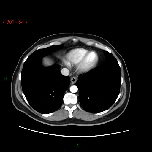 Ampullary carcinoma (Radiopaedia 56396-63056 B 10).jpg