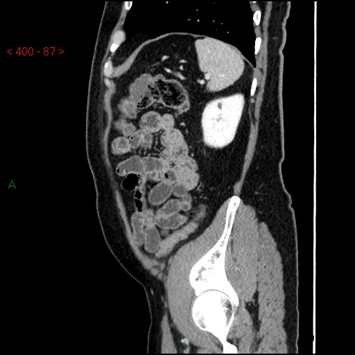 Ampullary carcinoma (Radiopaedia 56396-63056 D 86).jpg