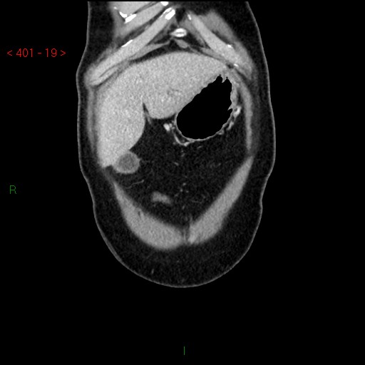 Ampullary carcinoma (Radiopaedia 56396-63056 E 18).jpg