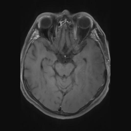 File:Amyloid angiopathy with inflammation (Radiopaedia 30360-31002 Axial T1 C+ fat sat 12).jpg